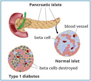 diabetes self management type 1