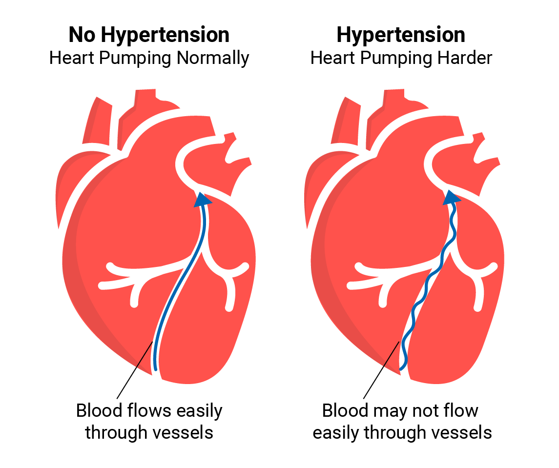 Hypertension Pathophysiology