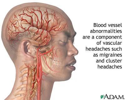 migraine management