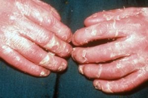 Acrodermatitis Enterpathica