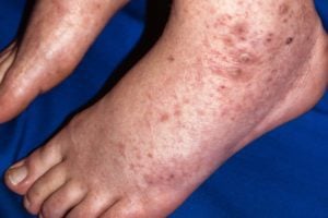 Leukocytoclastic Vasculitis in the feet