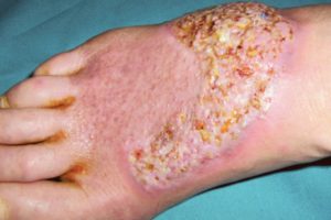 Pyoderma Vegetans on the Right Foot