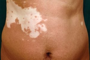 Vitiligo on the stomach region