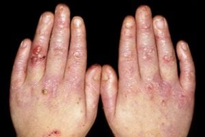 Epidermolysis Bullosa on bilateral hands