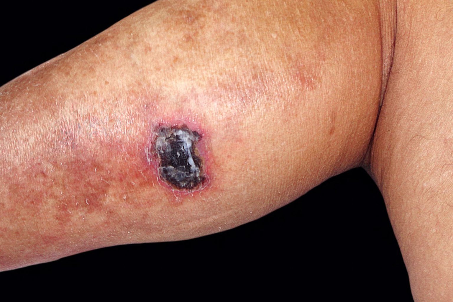 ulcerative-colitis-skin-rash