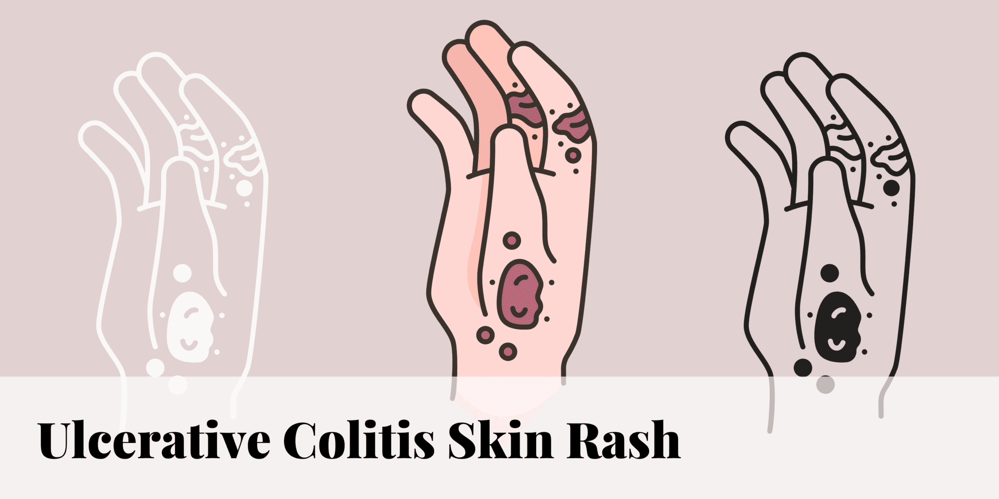 Ulcerative Colitis Skin Rash 0653