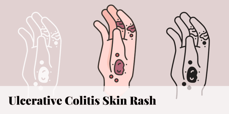 Ulcerative Colitis Skin Rash 9963