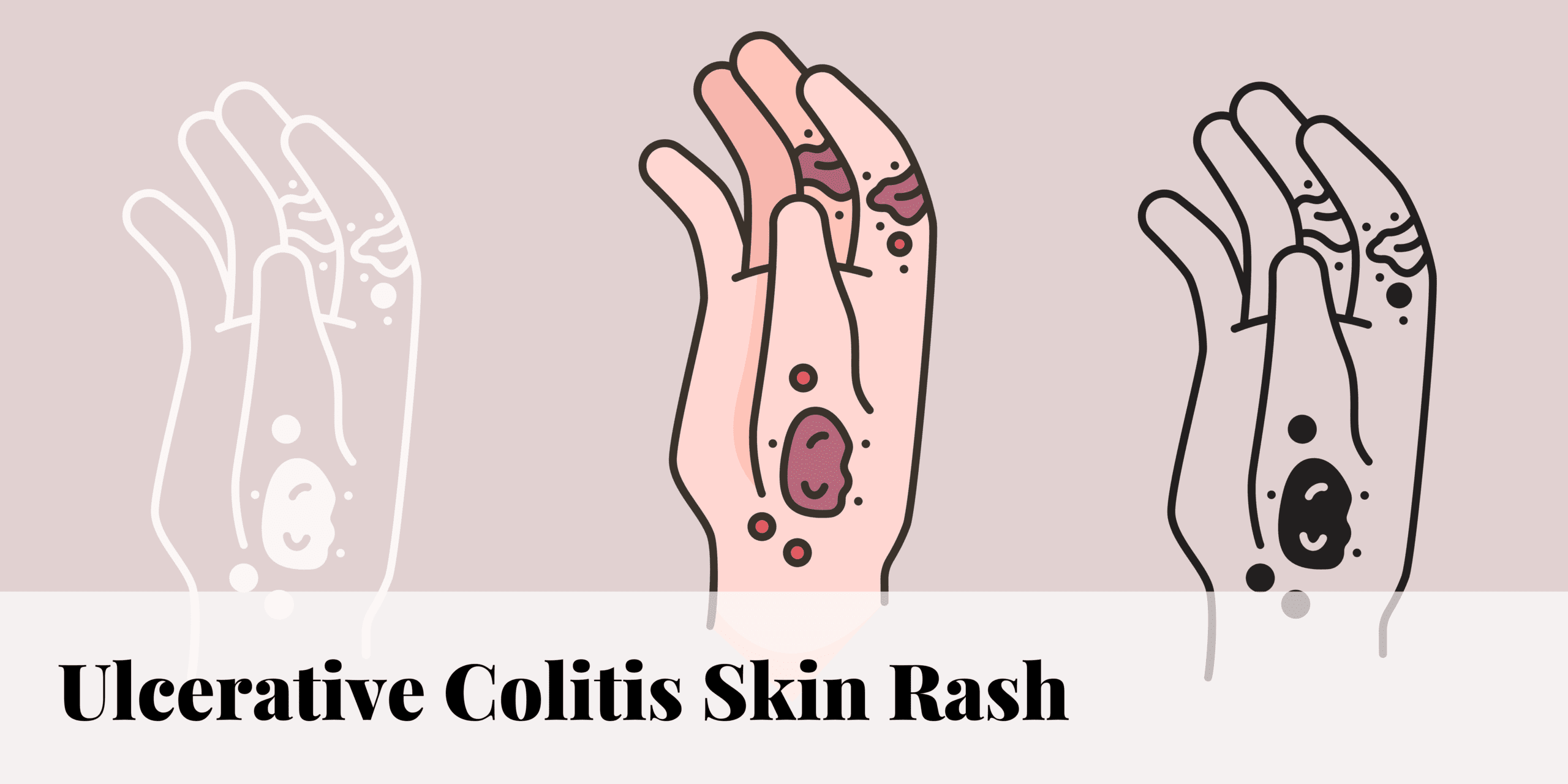 Ulcerative Colitis Skin Rash