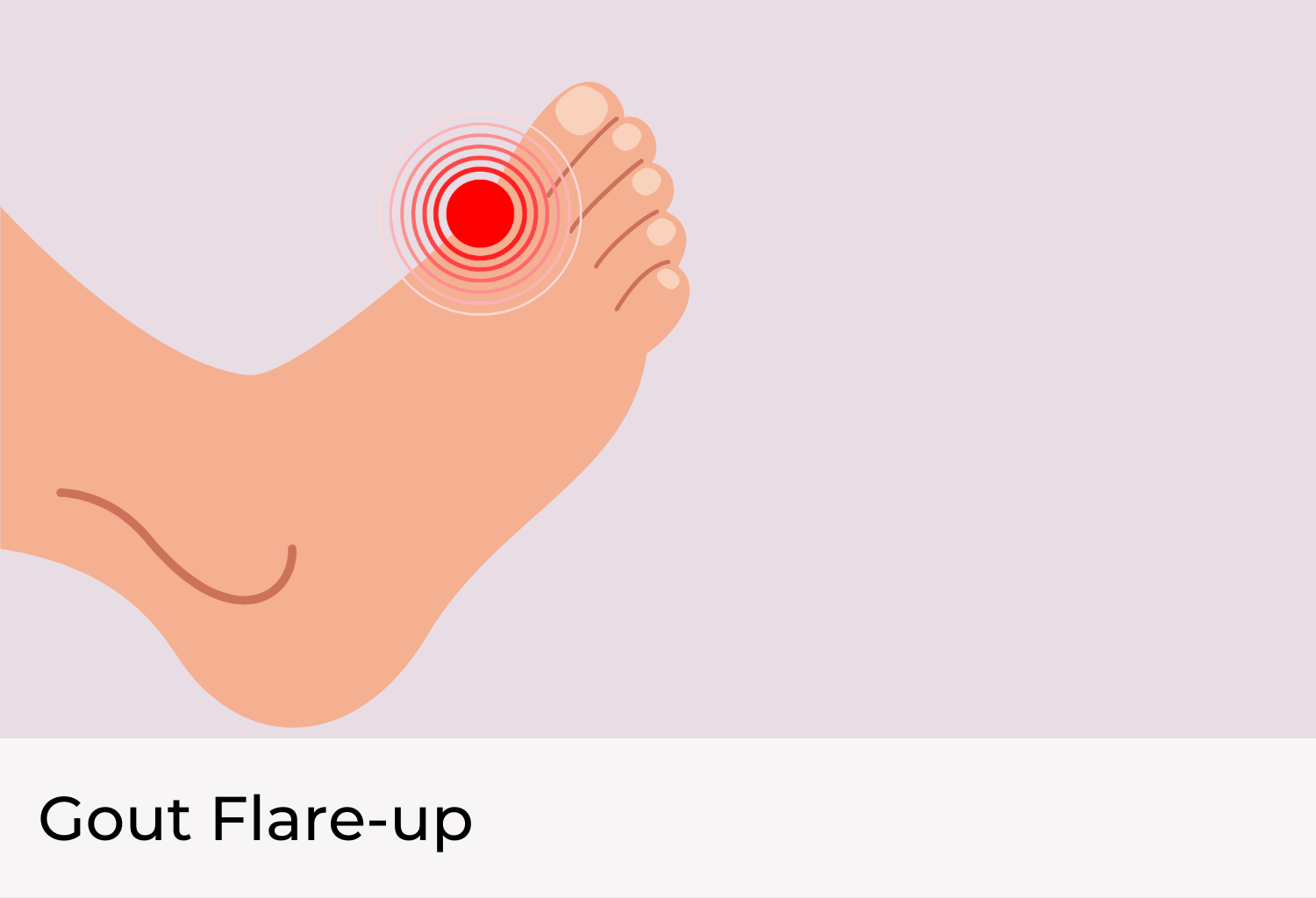 Gout Flare Up Pain in the Joints