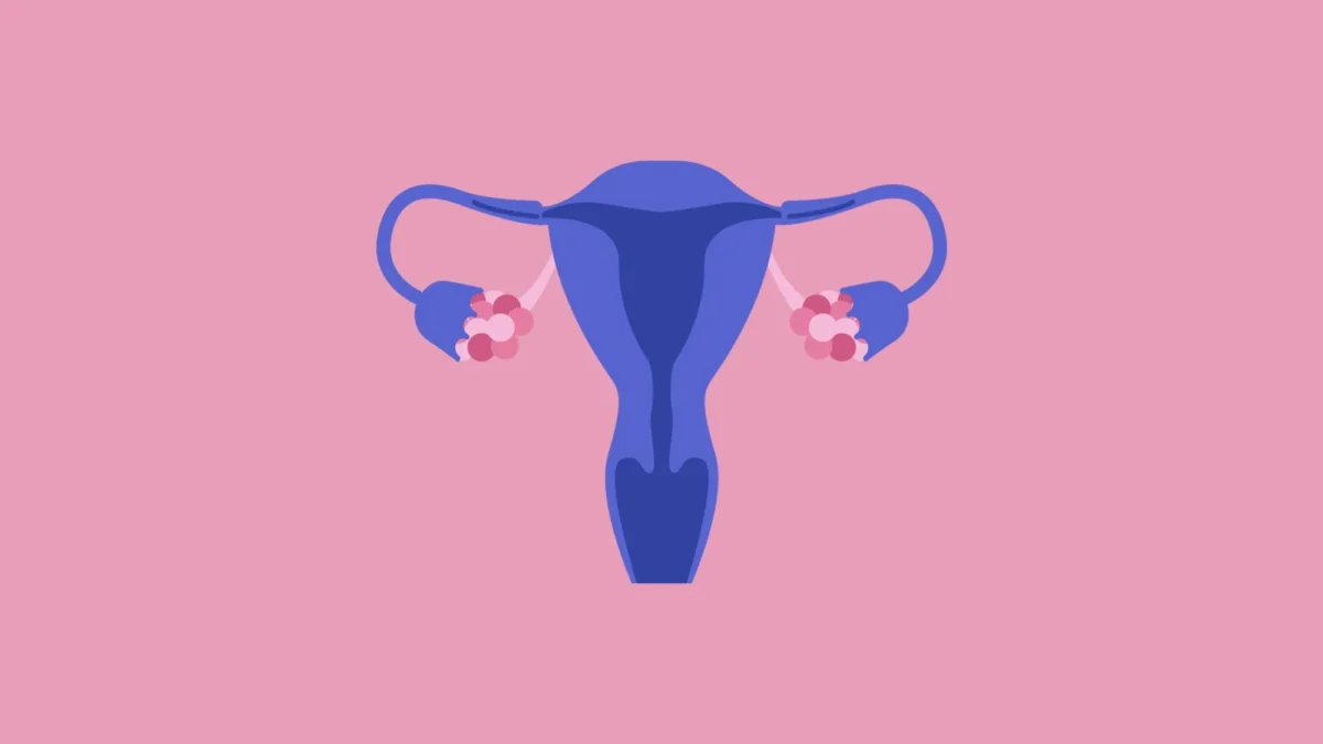 PCOS Hysterectomy Understanding the Benefits and Risks