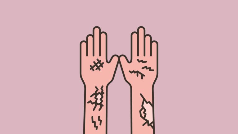 sarcoidosis skin lesions