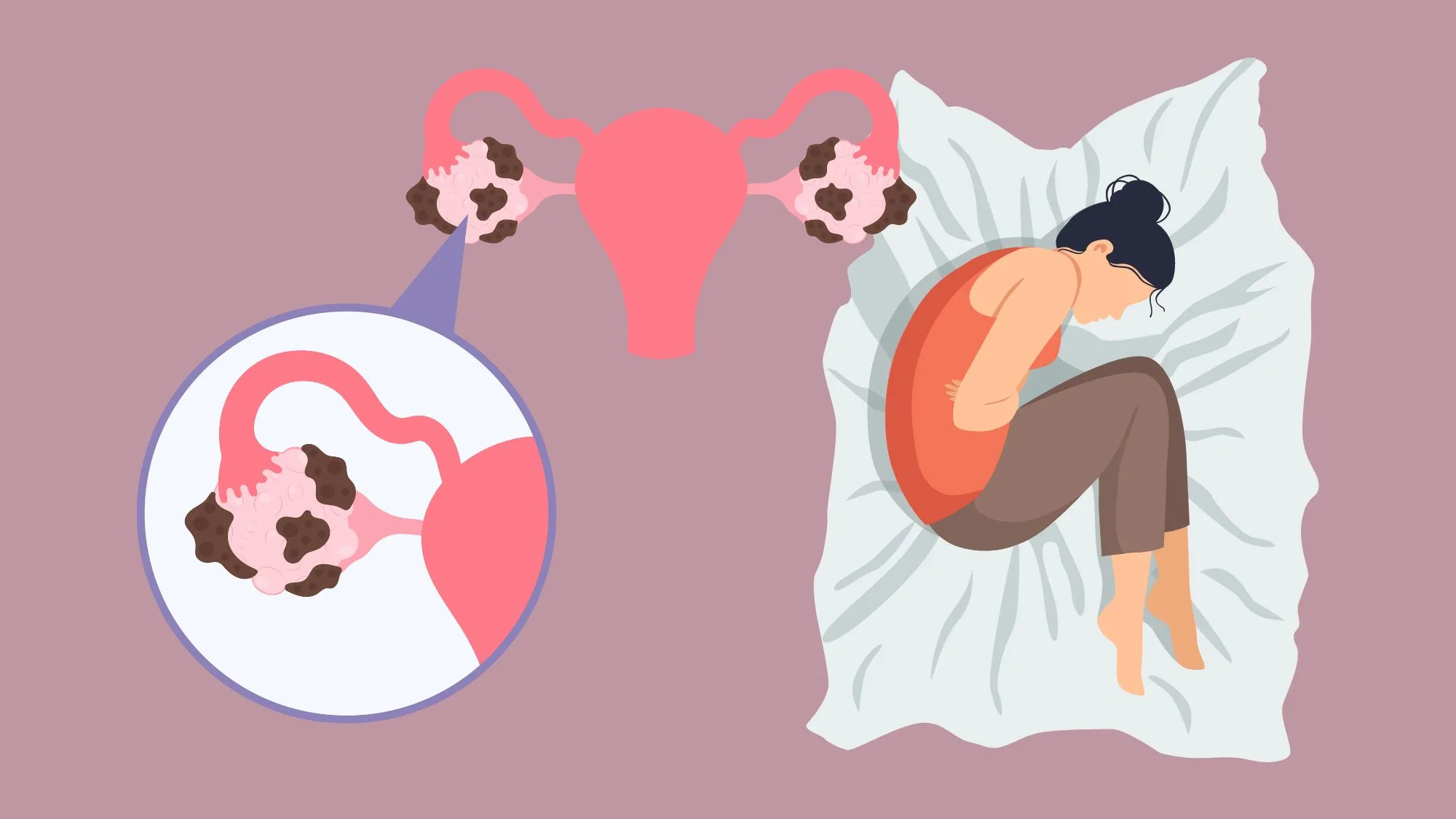 how to explain endometriosis pain